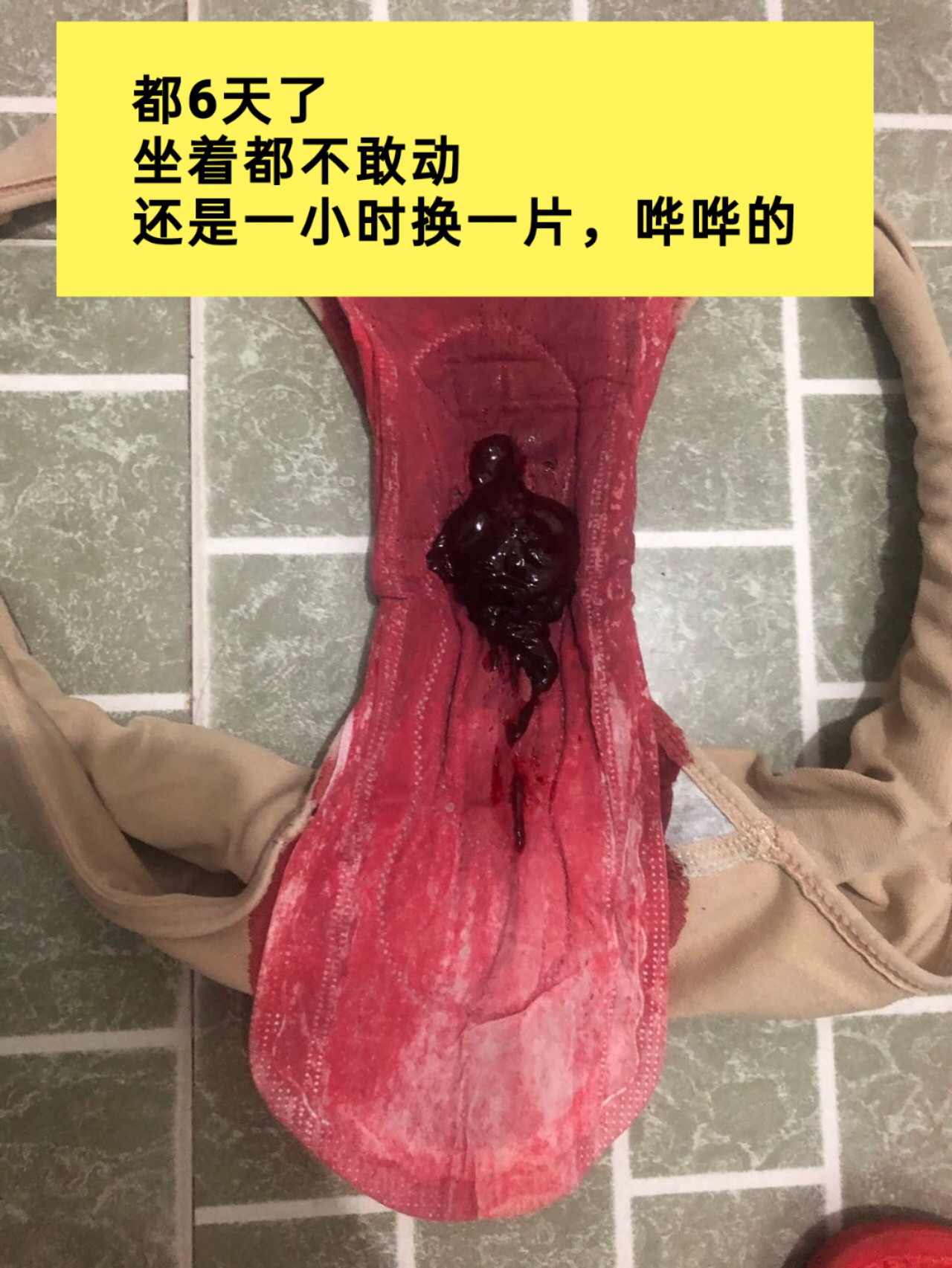 来领芳子啦!姨妈量少 痛经 宫寒淤堵 血块