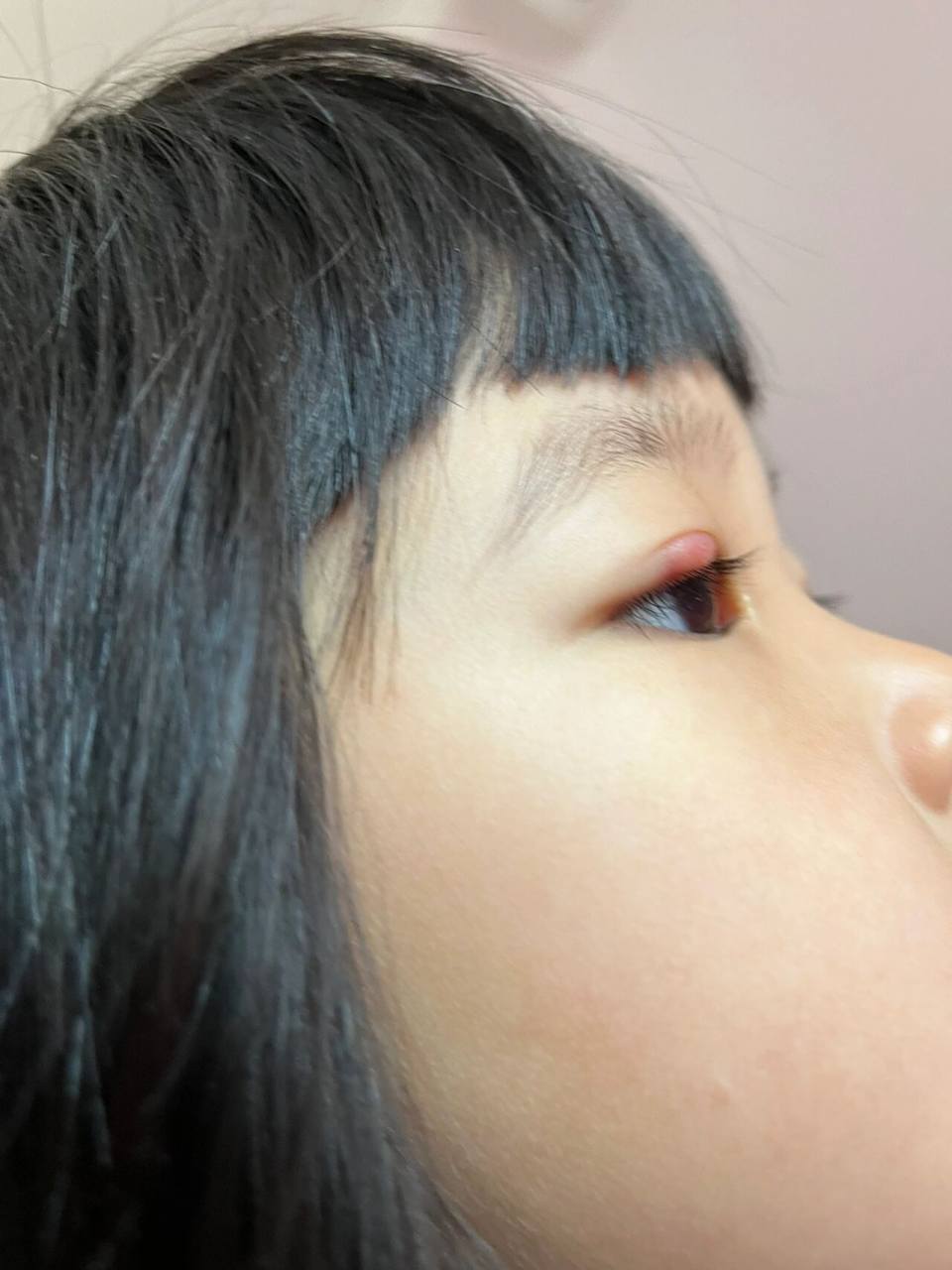 儿童霰粒肿 我的宝宝2岁多眼睛长了大包 前几个月 孩子眼睛大包不经意