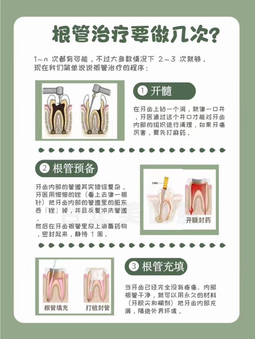 根管治疗一般要几次