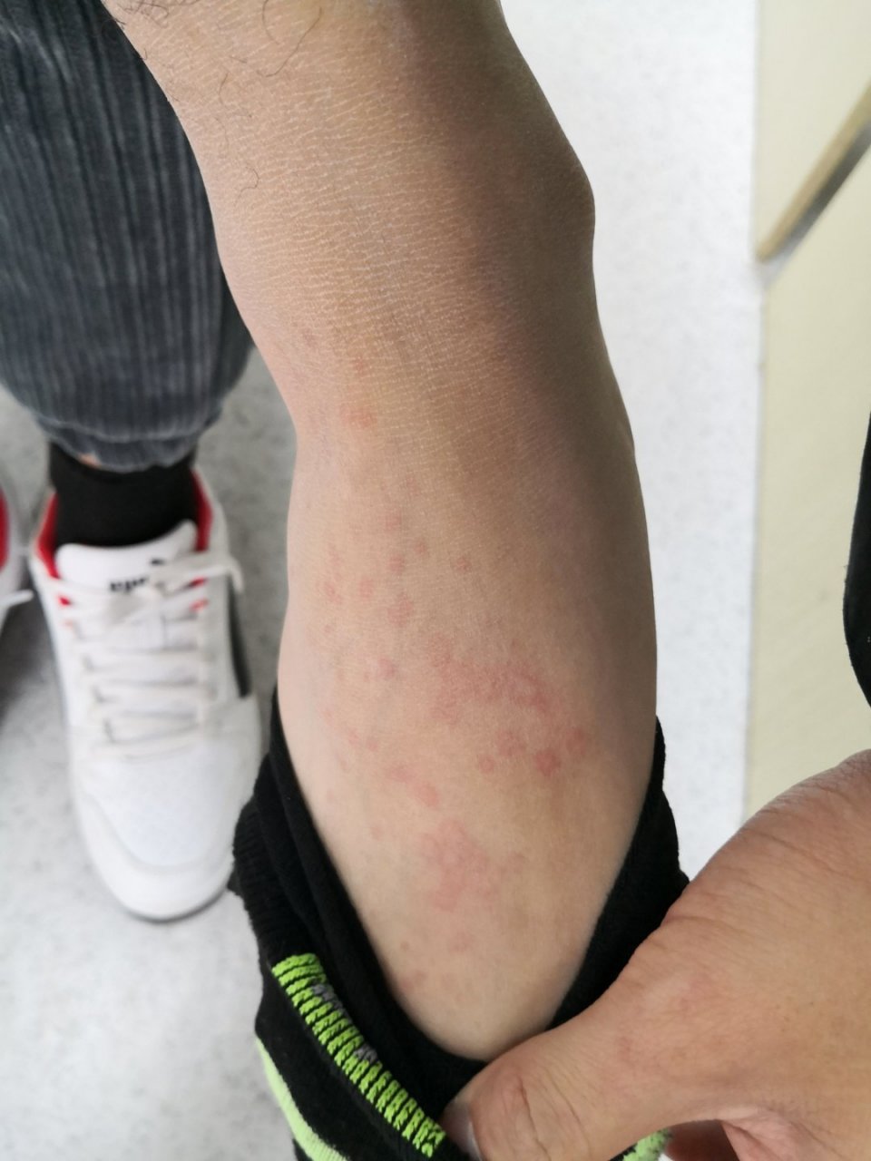 红斑丘疹风团症状#荨麻疹##药物过敏