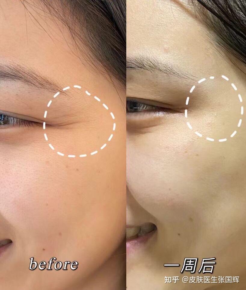 请问一个人三十多开始打肉毒去皱到了五十岁会是什么结果