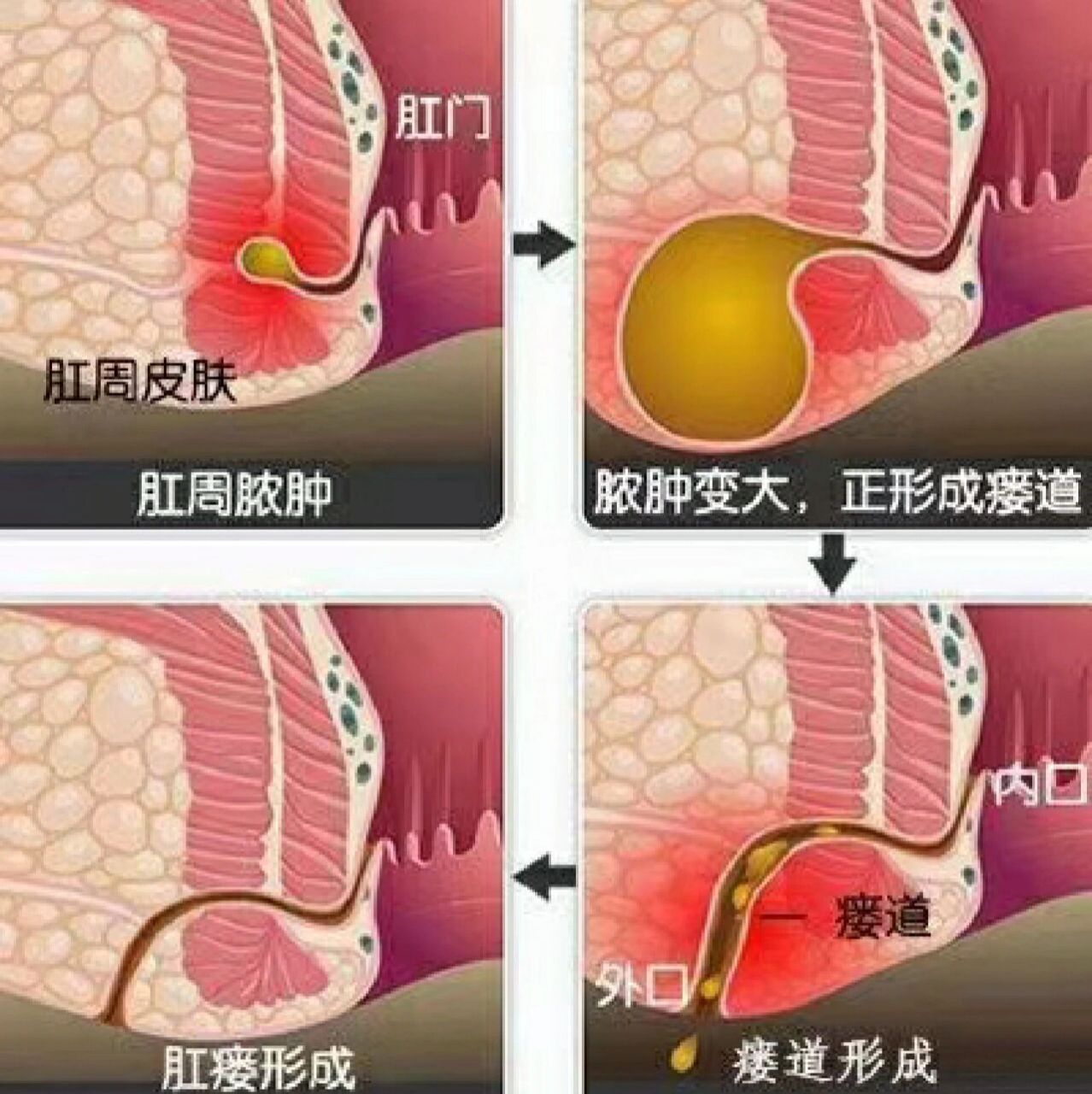 肛周脓肿: 肛周脓肿,又称直肠肛管周围脓肿,肛门直肠周围脓肿,是指