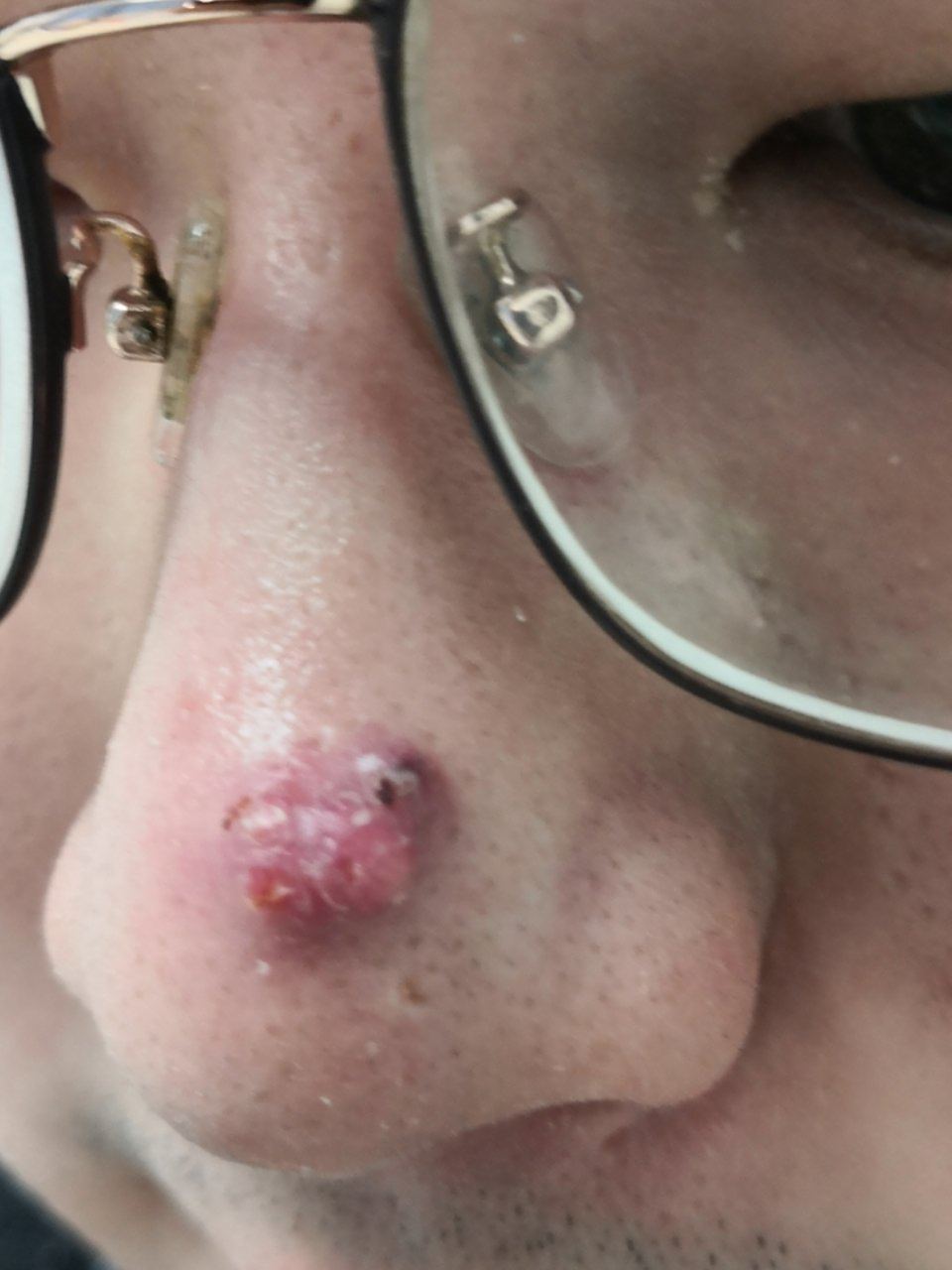 可以使用激光治疗配合药物口服涂擦.#囊肿性痤疮