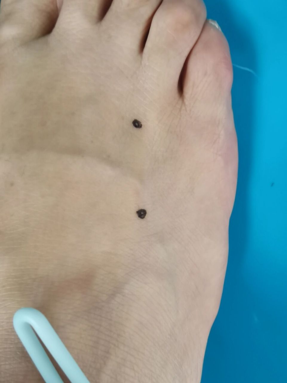 木斗,木留穴 第三跖骨与第四跖骨之间,距跖骨与耻骨关节五分处是木斗