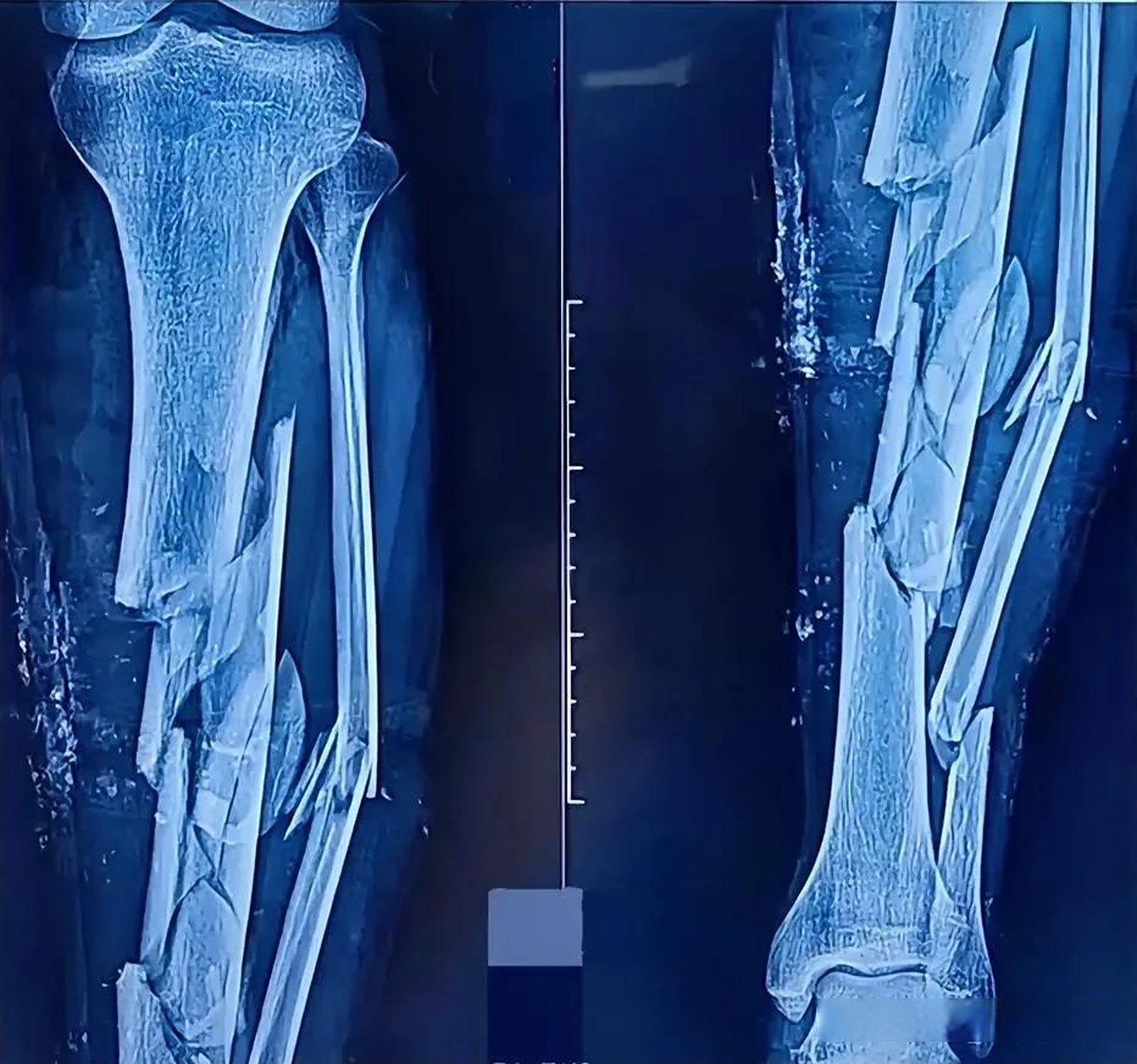 胫腓骨粉碎性骨折