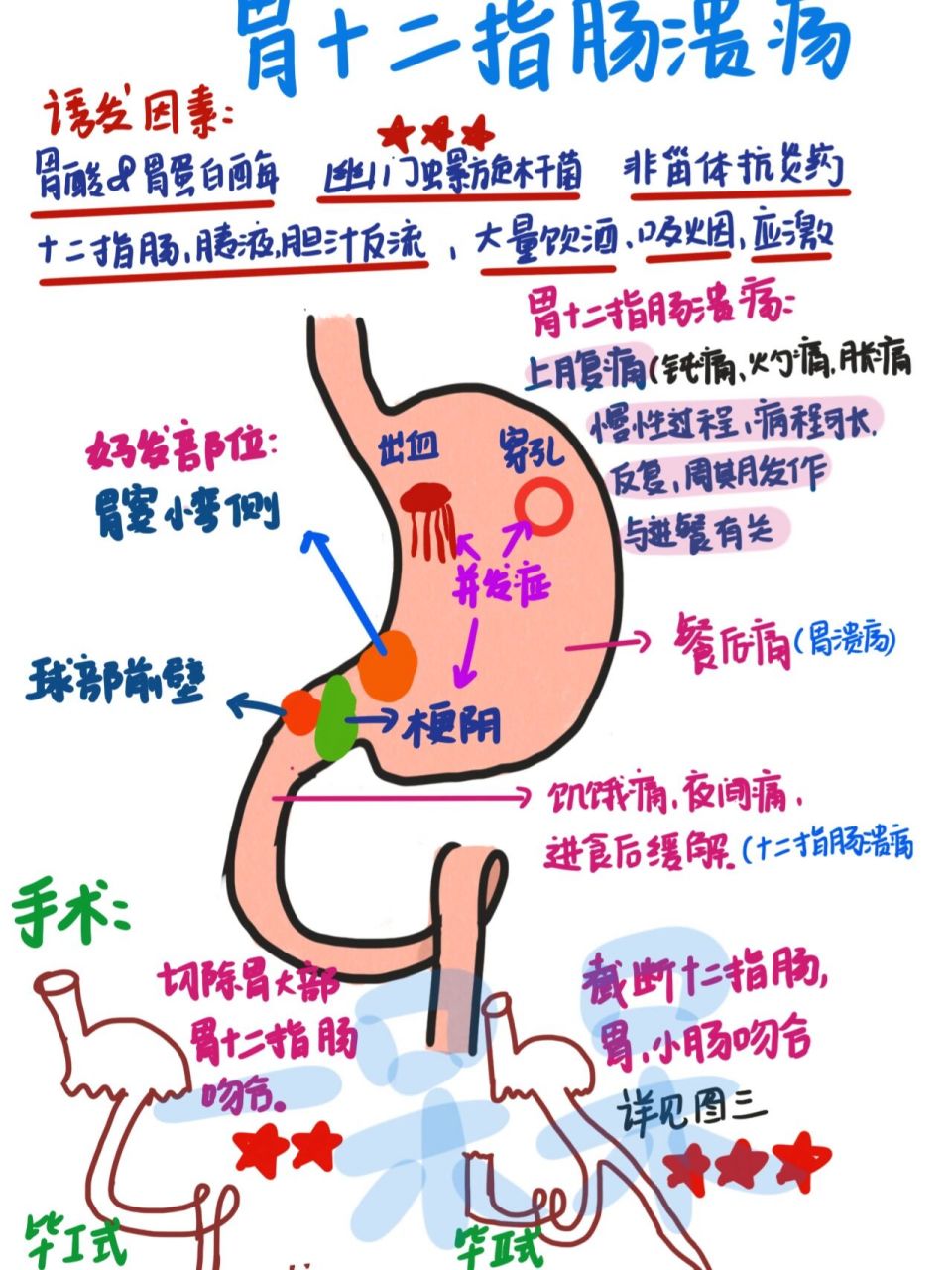 97主要病因有:胃酸,胃蛋白酶,幽门螺旋杆菌,非甾体抗炎药,12指肠