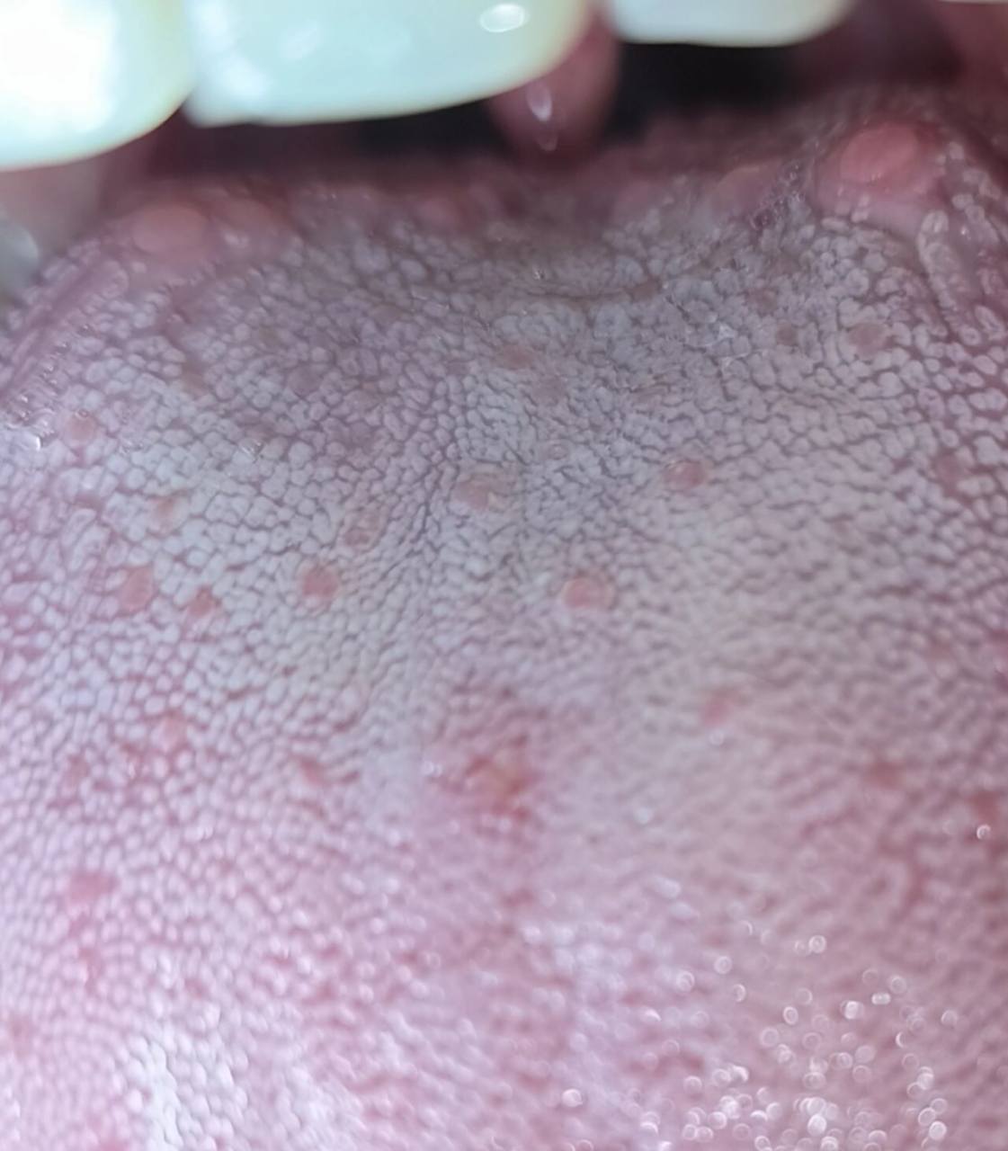 家人们,有99了后舌根起疱疹的吗?