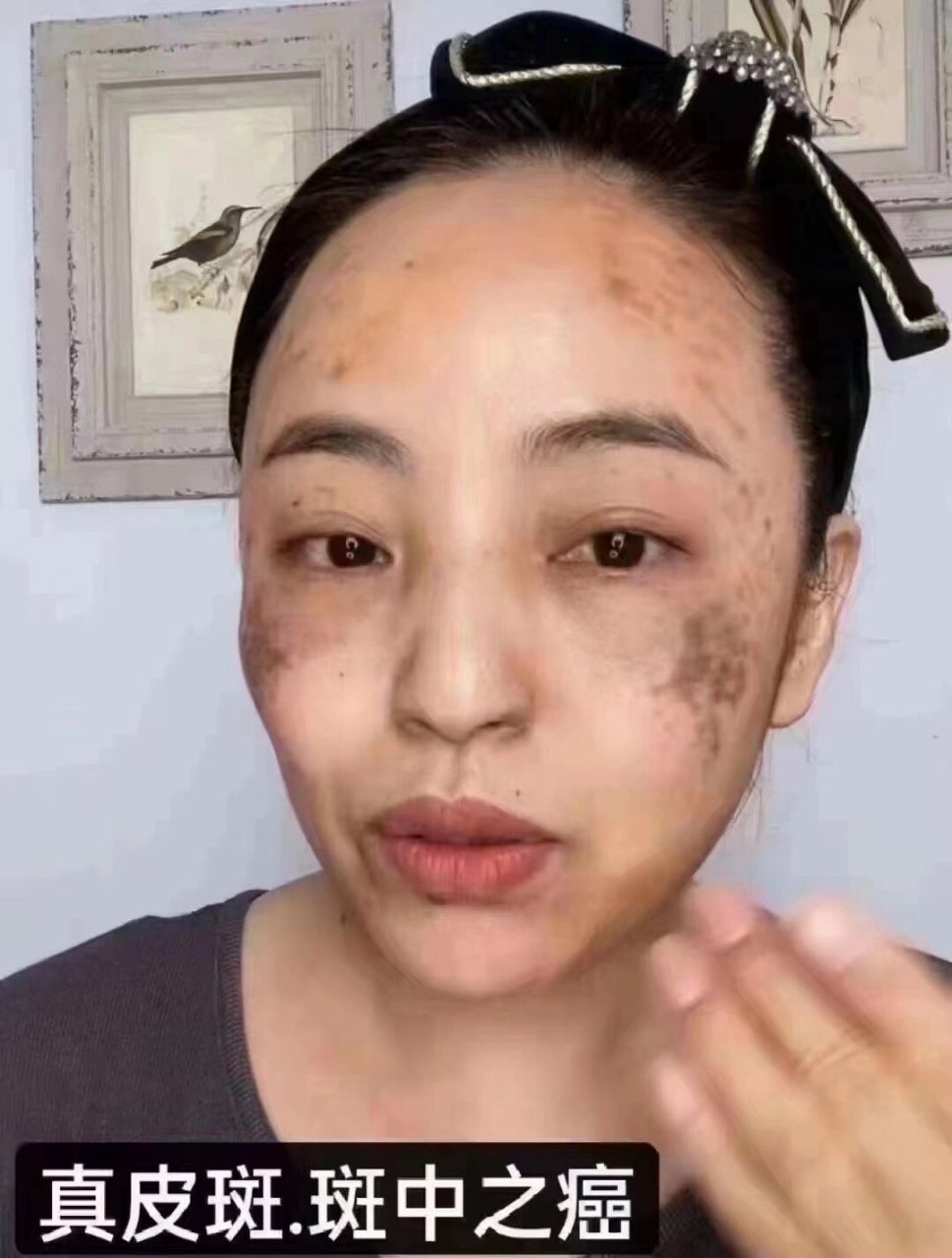 真皮斑又叫"颧骨母斑"斑中之癌 真皮斑最可怕的是初期不重视,会从颧骨