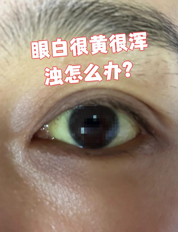 眼白很黄很浑浊可能是多种原因引起的,需要根据具体原因来处理