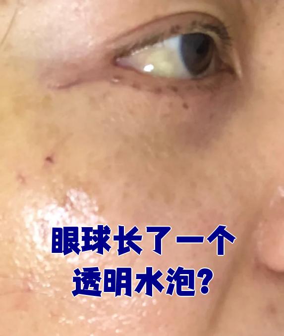 眼球上出现透明水泡,最常见的原因是结膜淋巴管堵塞或泡性结膜炎