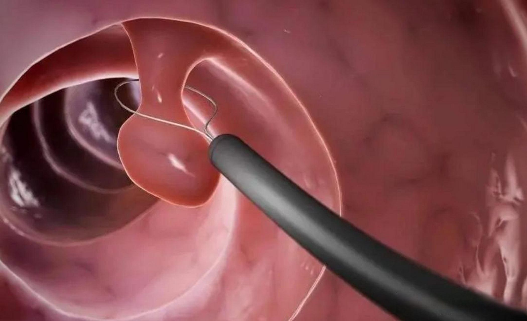 身体出现肠息肉,排便时会出现2个变化,有必要切除吗?