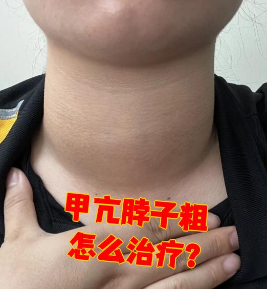 甲亢脖子粗的治疗方法主要有三种:一般治疗,药物治疗和手术治疗