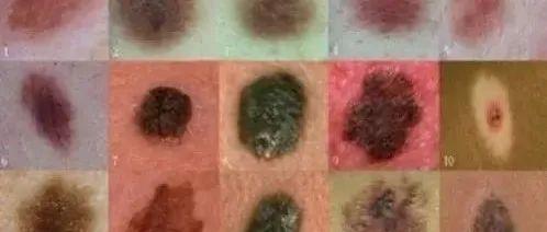 学习笔记口腔黏膜黑色素瘤专家共识