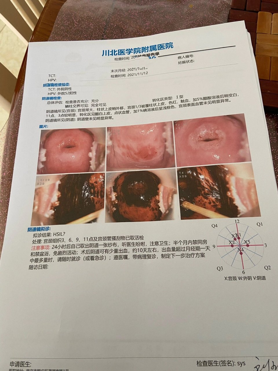 活检结果不理想,加做了免疫组化 97做完活检后,会塞一块纱布在阴道