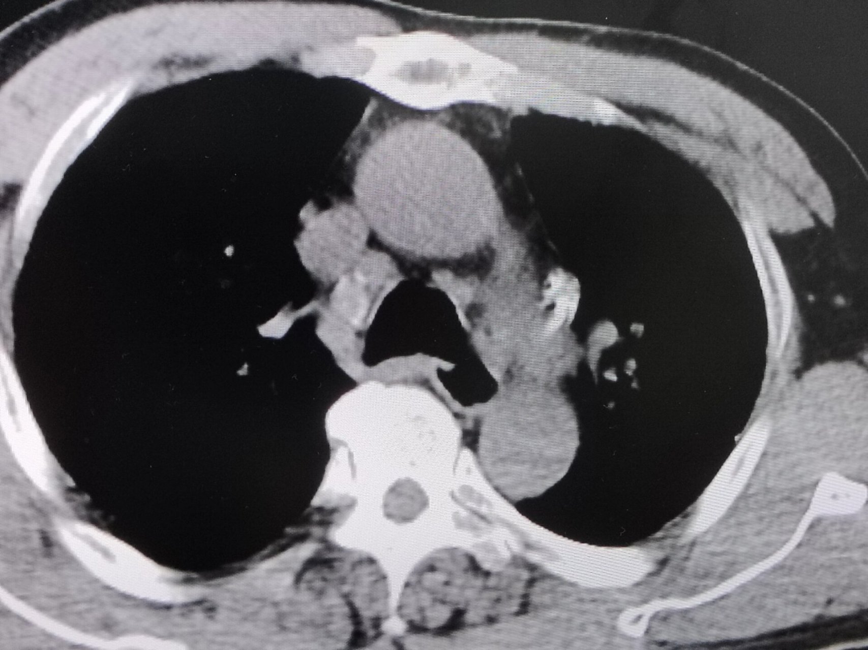 矽肺ct表现 两肺见弥漫多发粟粒结节影,可以看到两肺门,纵隔淋巴结轻