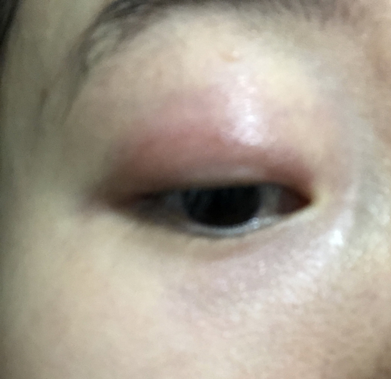 护肤|眼皮/皮肤过敏红肿必备急救药物92 从前年开始我的眼皮就突然