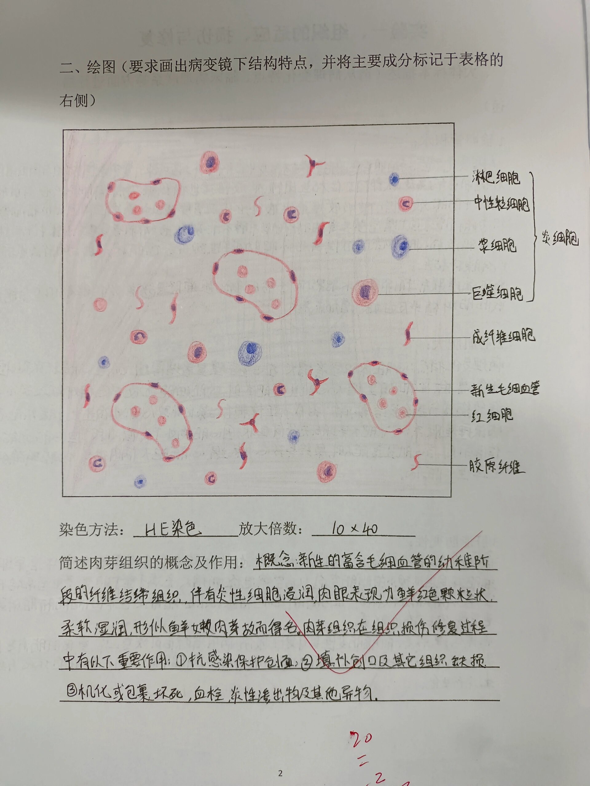 肉芽组织病变手绘图图片