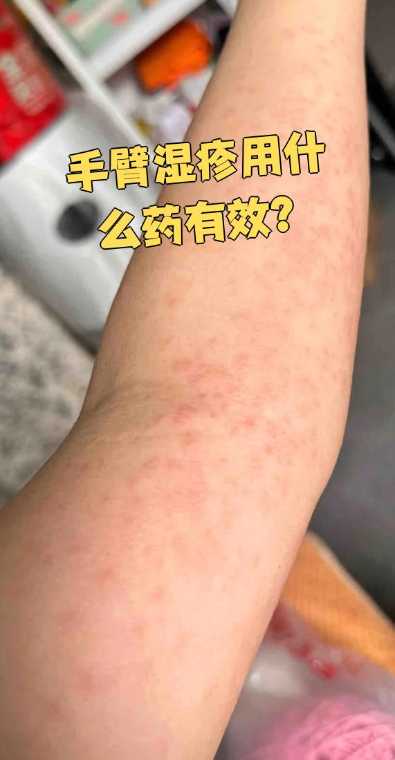 这种情况会引起皮肤剧烈瘙痒,起红疹等症状