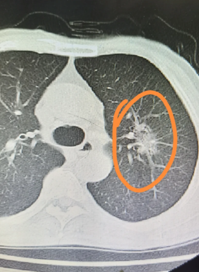 右肺上叶为什么恶性多发结节为什么在线 右肺上叶为什么恶性多发结节为什么在线