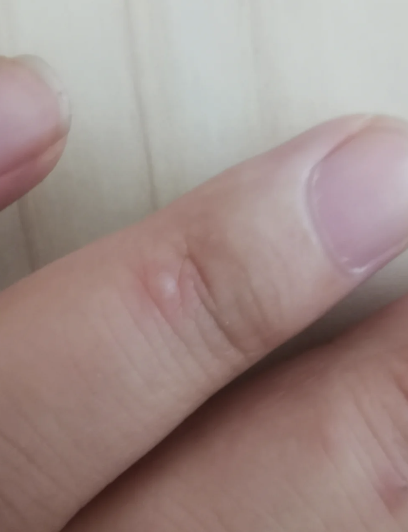 手指上长小疙瘩常见的原因有接触性皮炎,汗疱疹和疣