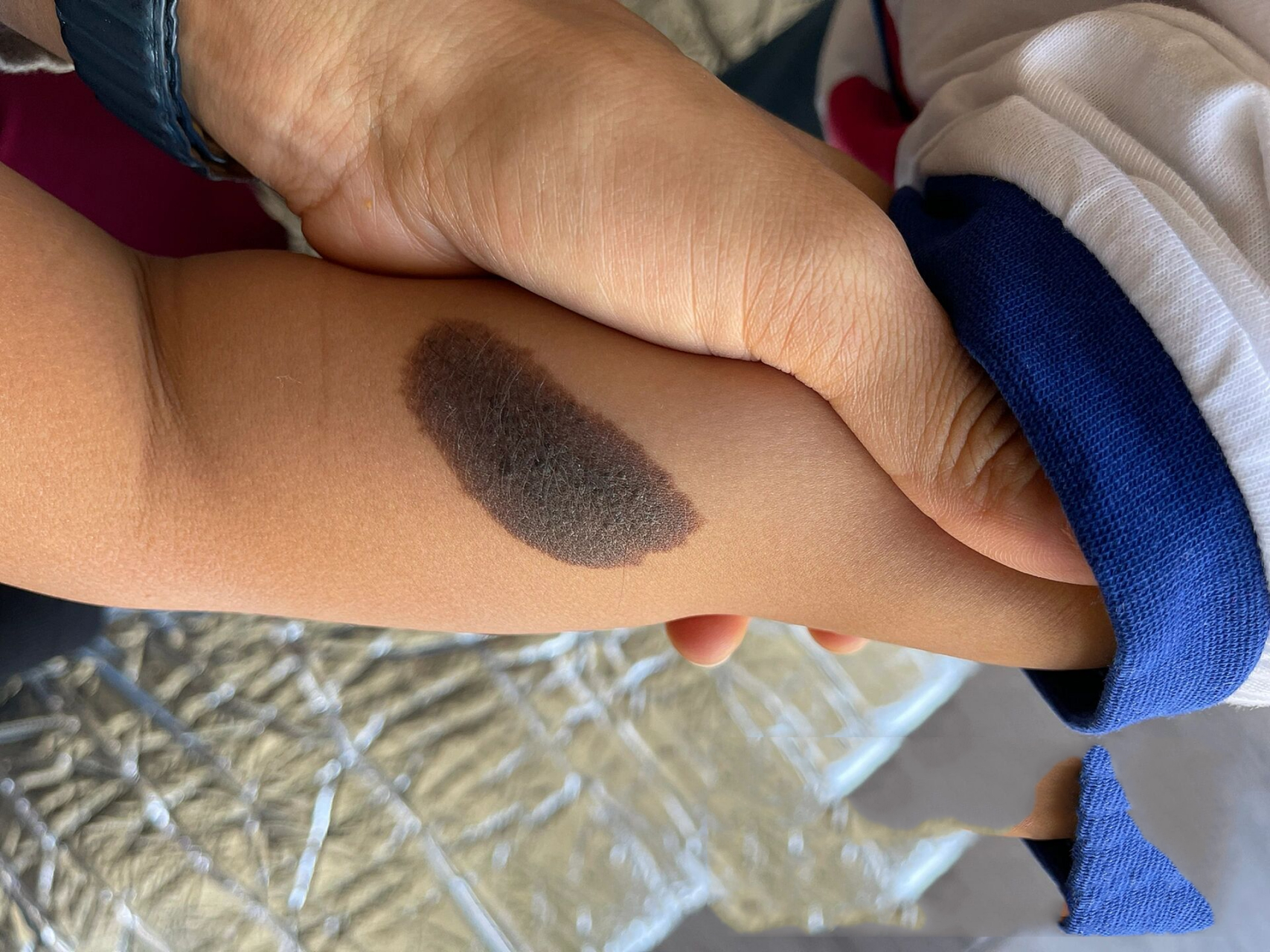 首都儿研所|黑色素痣治疗方法 弟弟出生的时候就有