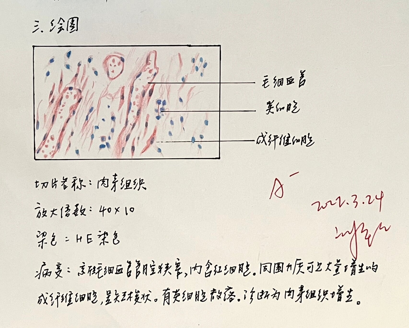 急性蜂窝织炎红蓝铅笔图片