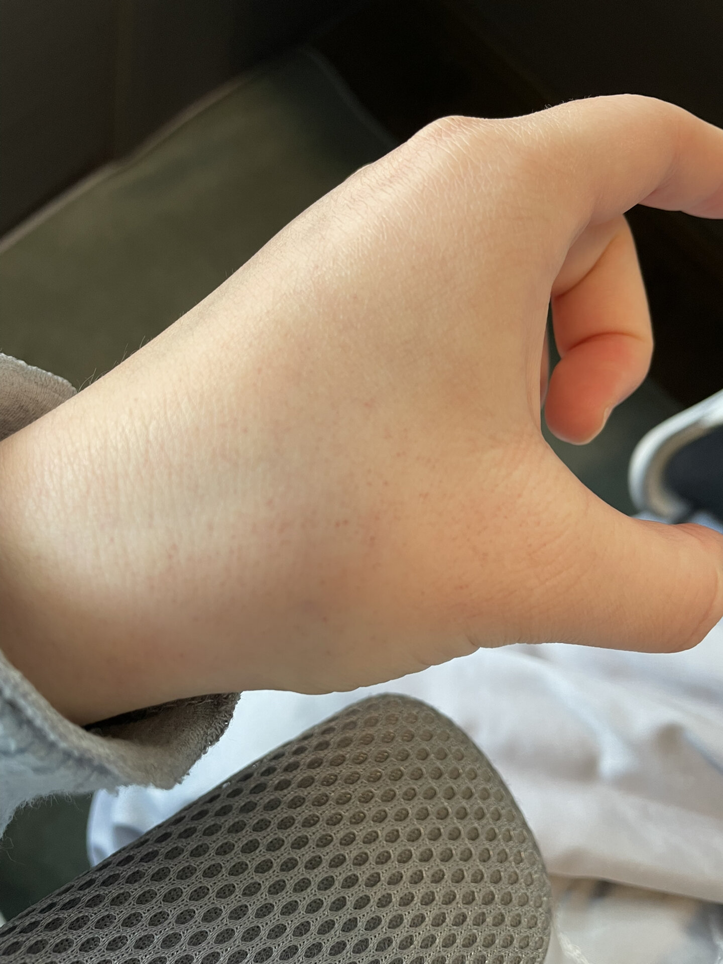 手背上突然起了小红点,不疼不痒,也没有凸起 手背上突然起了小红点,不