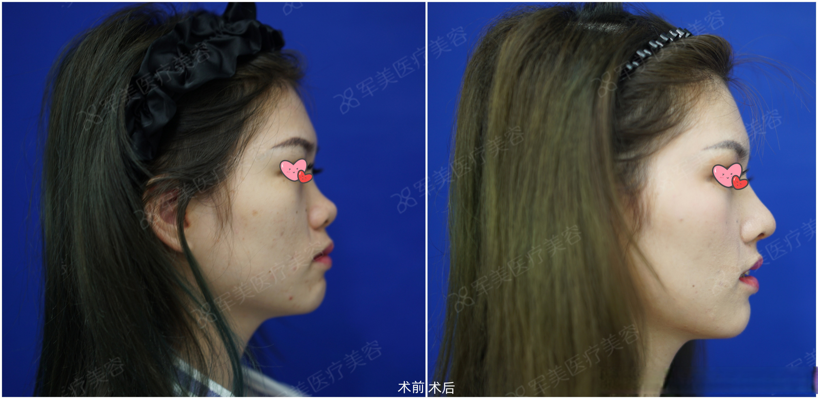 鞍鼻就是从山根到鼻梁不同程度凹陷,只有鼻尖上翘有一定高度,形似马鞍