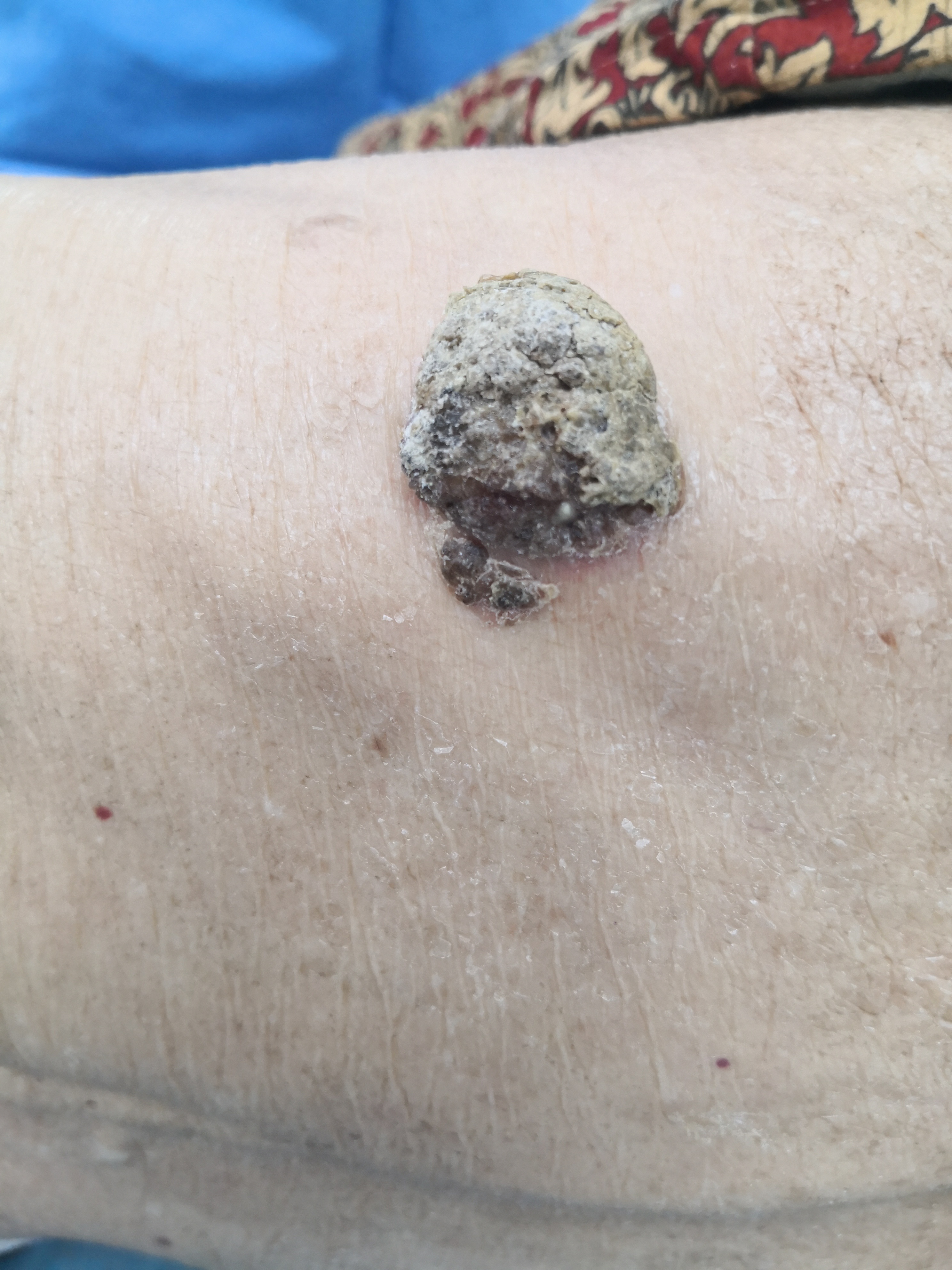 老年女性背部皮肤增生.@纪秀军皮肤科主任医师的动态