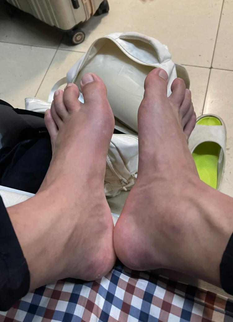 大脚趾向下弯曲时疼痛,常见原因有外伤,腱鞘炎和痛风性关节炎