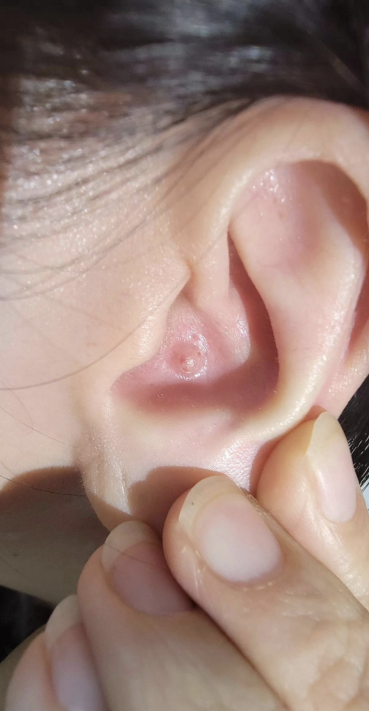 中耳炎几天后耳朵感觉堵住,通常是因为耳内分泌物堵塞或鼓室内有