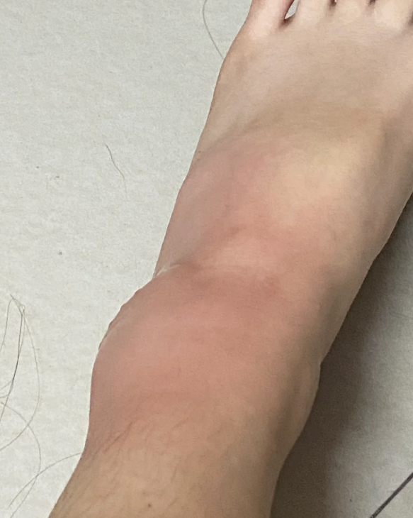 脚肿了想快点消肿,可以试试下面这些方法