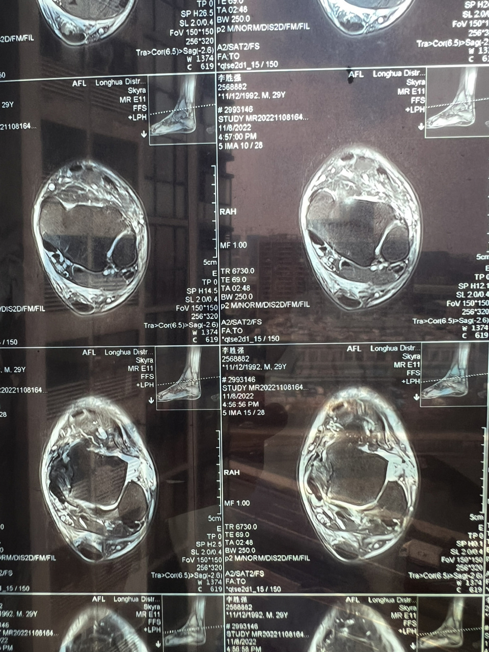 距腓前韧带重建第二步!