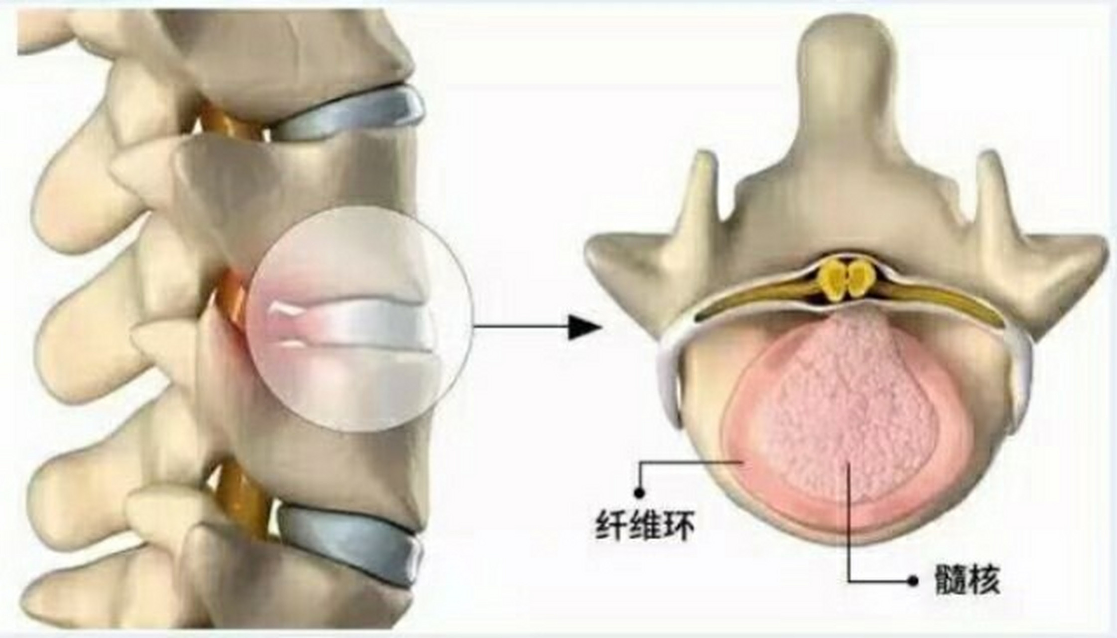 纤维环由透明软骨构成图片