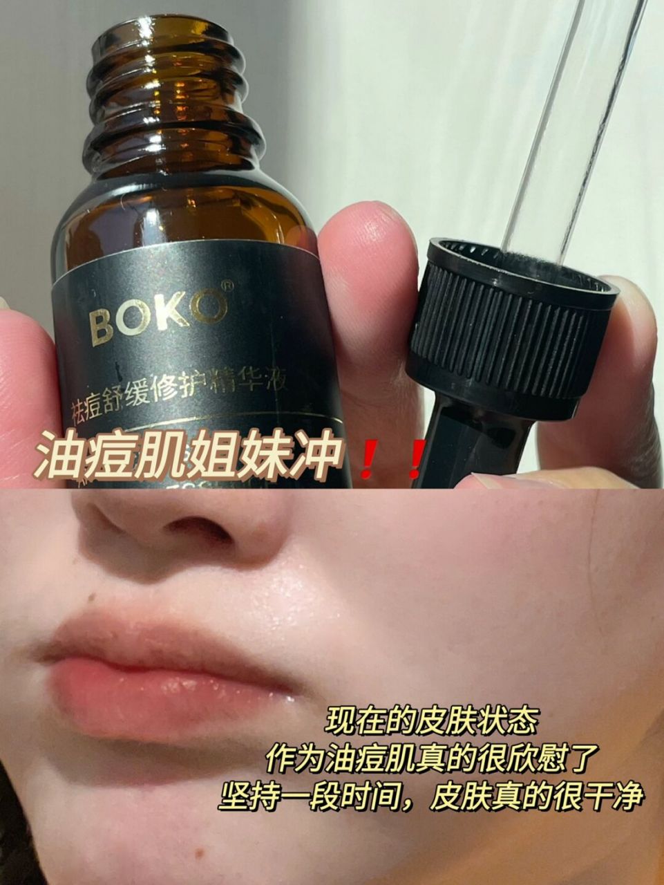 我不允许还有人不知道这款祛痘精华7575 boko祛痘精华[期待] 前