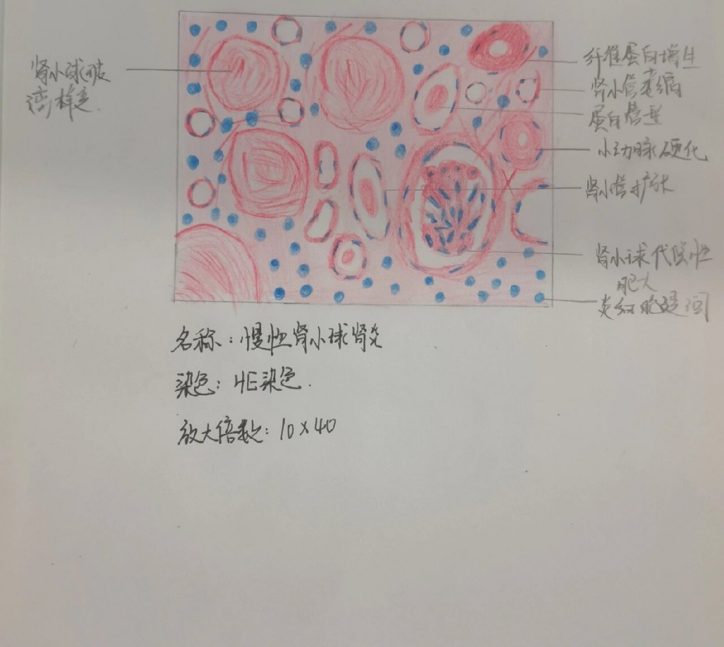 慢性肾小球肾炎红蓝铅笔图 重点内容: 肾小球玻璃样变 肾小球集中现象