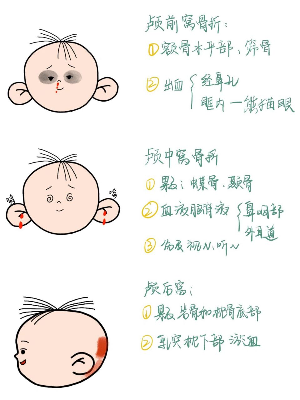 医学生笔记|颅底骨折 🌟这次画的是颅底骨折 🌟对于熊猫眼印象深