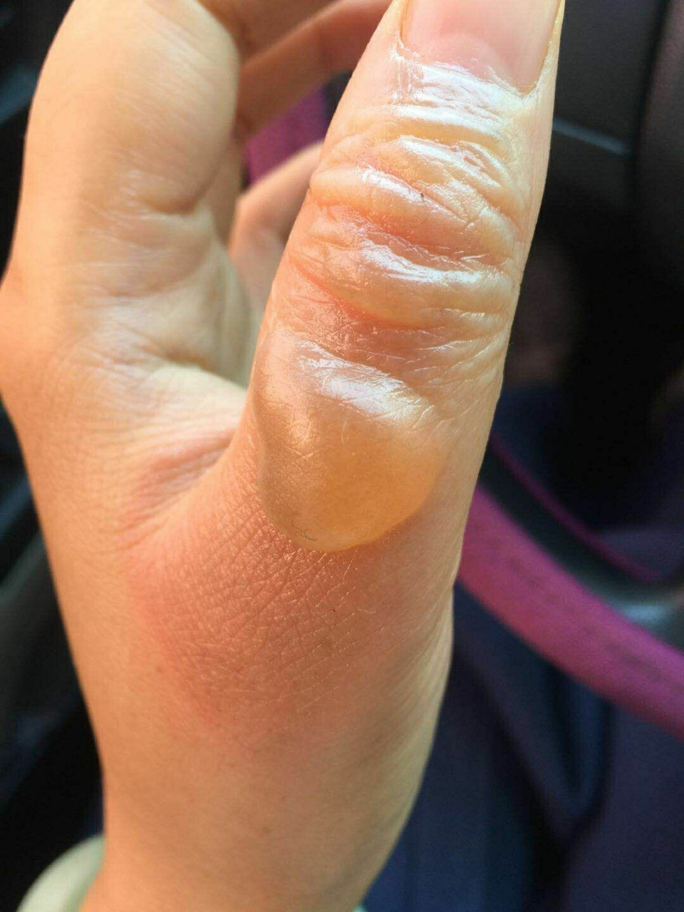 不小心烫伤怎么办? 10月27日晚10