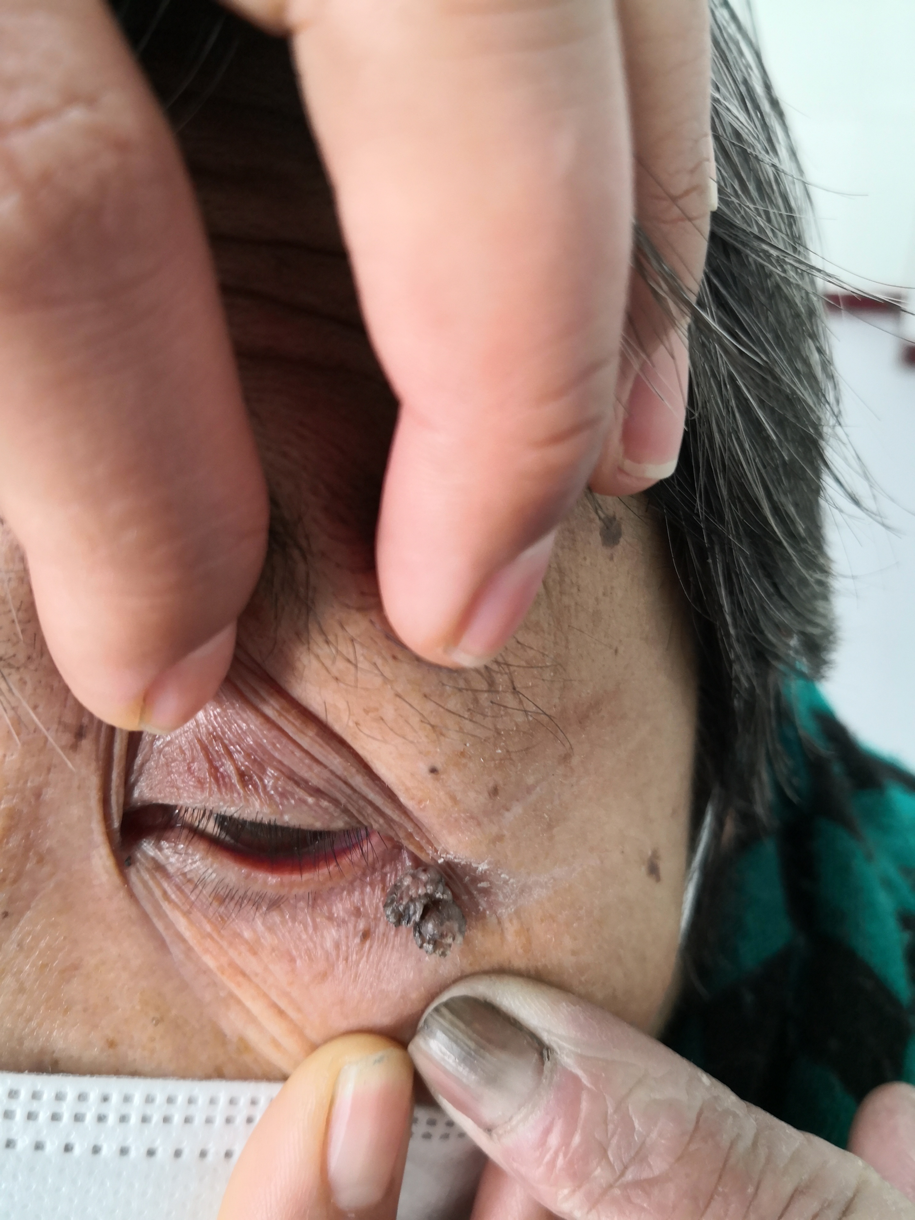 外眼角下方的疣状物.激光治疗去除前后即刻对比图.#美容##激光美容