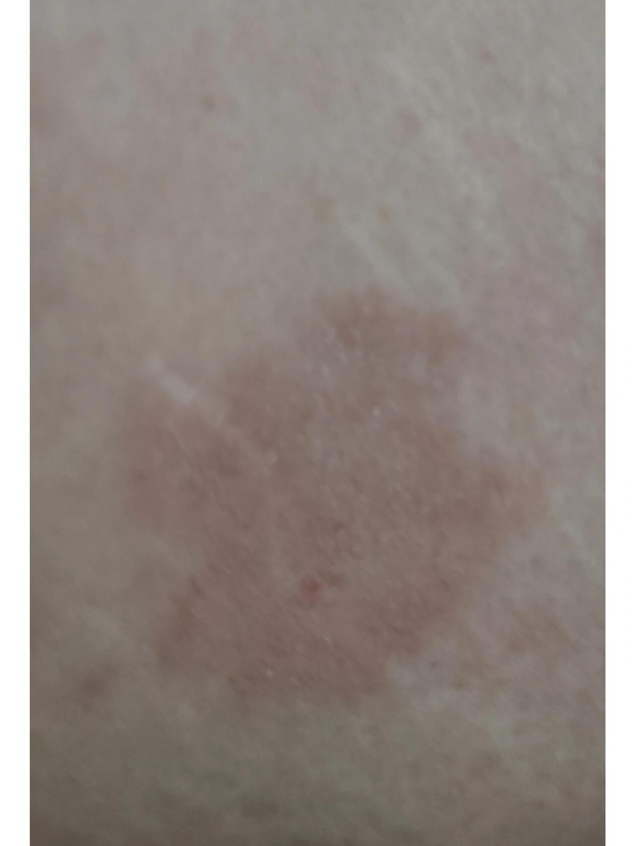 身上长了一块红色斑?好几天了,也不疼不痒就是有起皮的现象