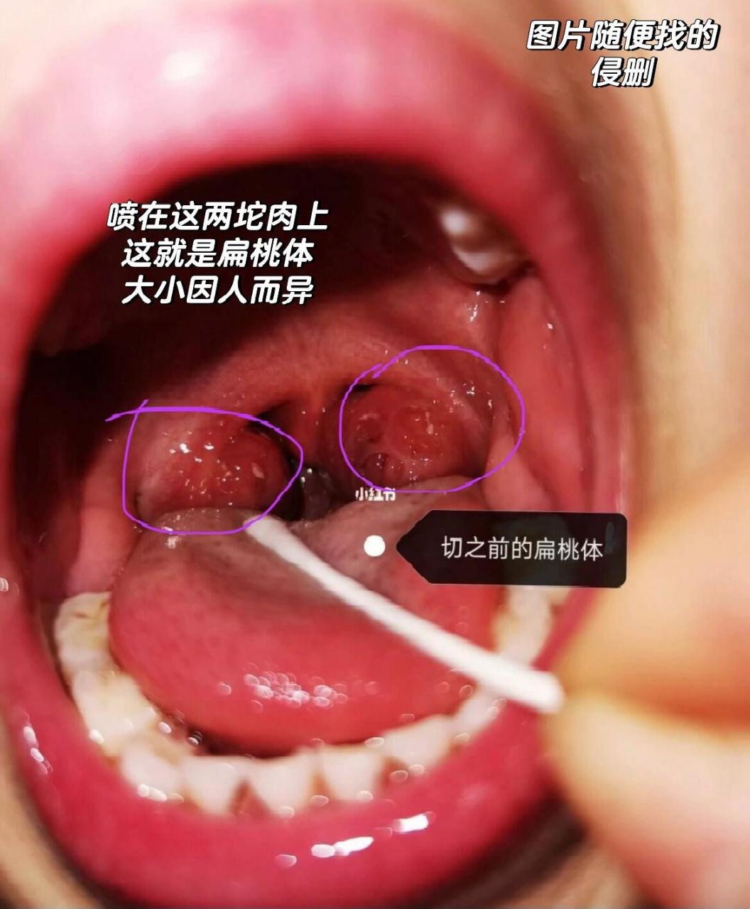扁桃体化脓两年再没复发 我21年发过一个帖子自己扁桃体老是反反复复