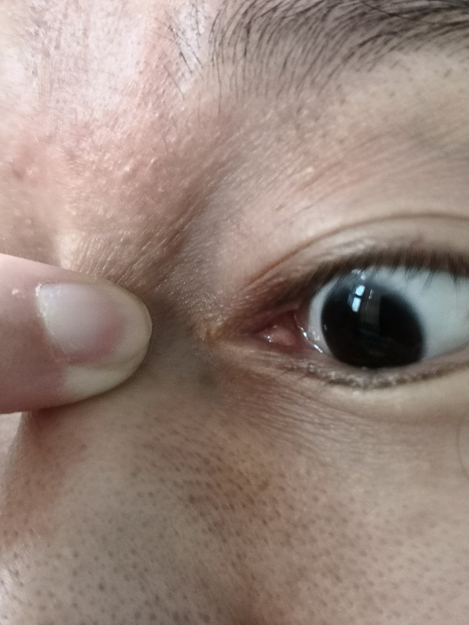 眼睑内眼角褶皱部位的颗粒物.#解决皮肤问题专注皮肤美容##皮赘