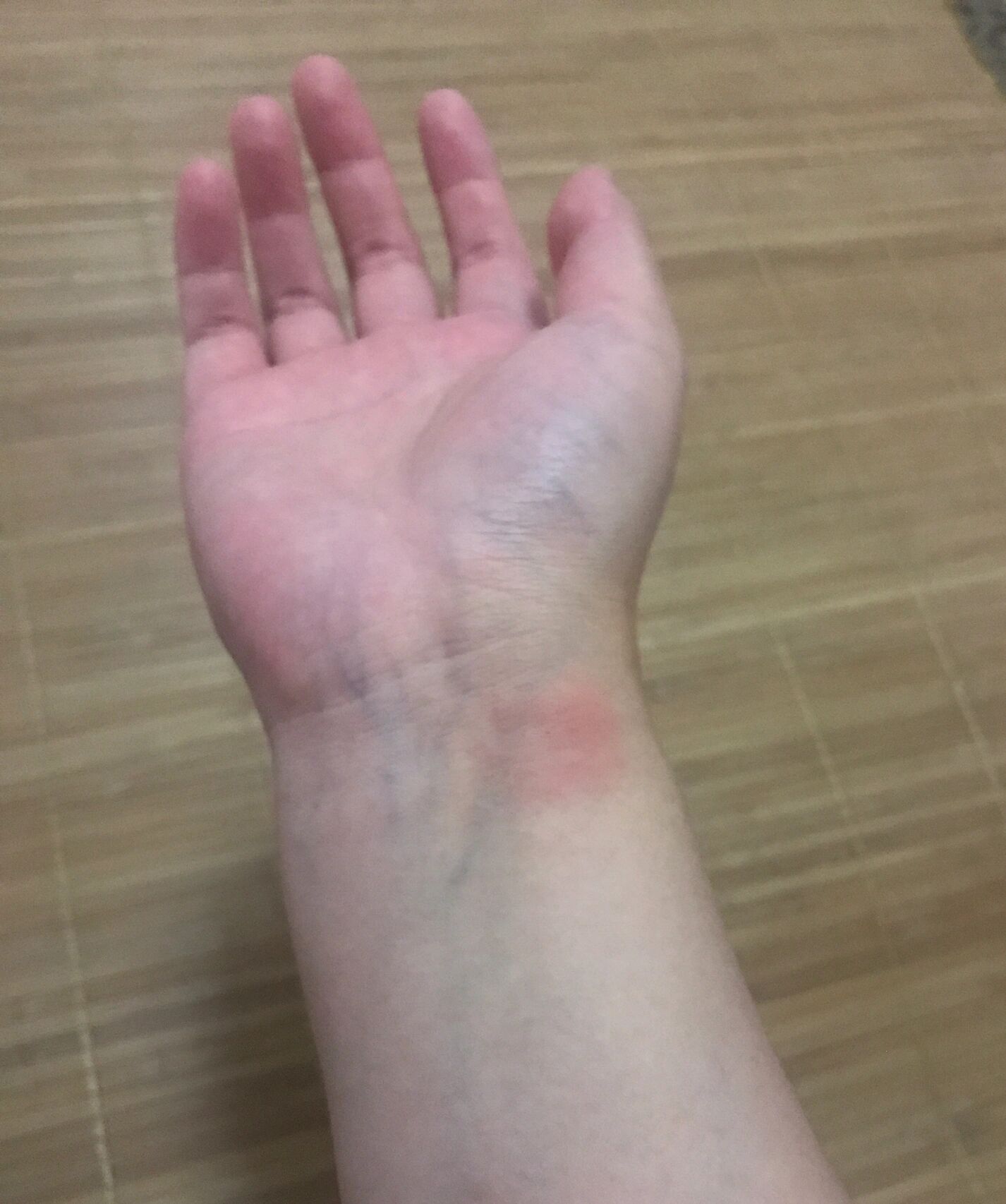 焯?破伤风皮试一个星期后过敏了?