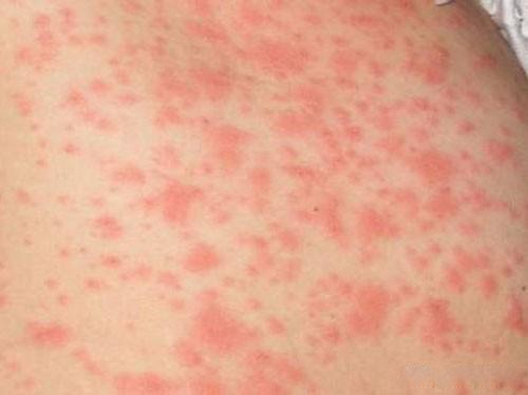 2,乳房皮肤过敏多有明确的过敏原(近期接触乳房皮肤的衣物).