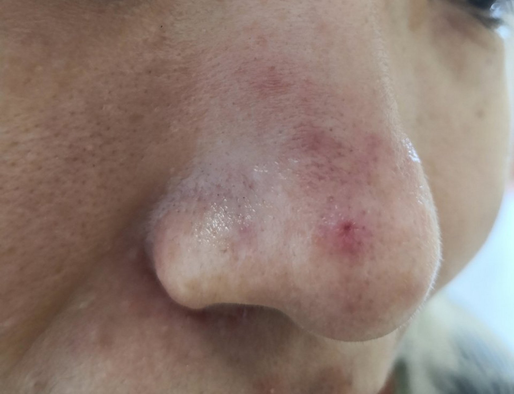 酒糟鼻症状.结节红斑可以使用激光治疗配合药物涂擦治疗减轻症状.