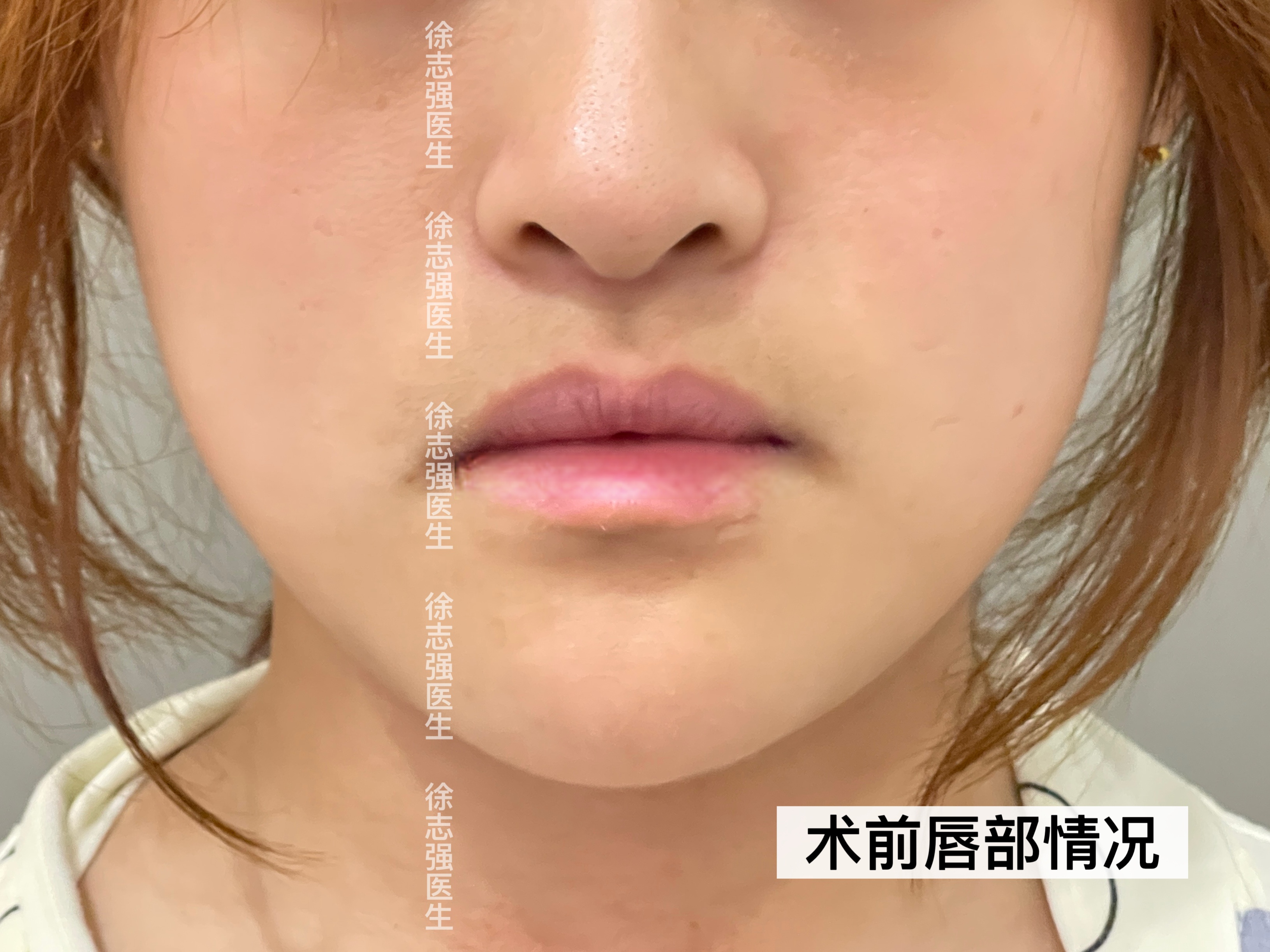 画线设计中:上唇组织适当切除,唇形轮廓曲线调整.