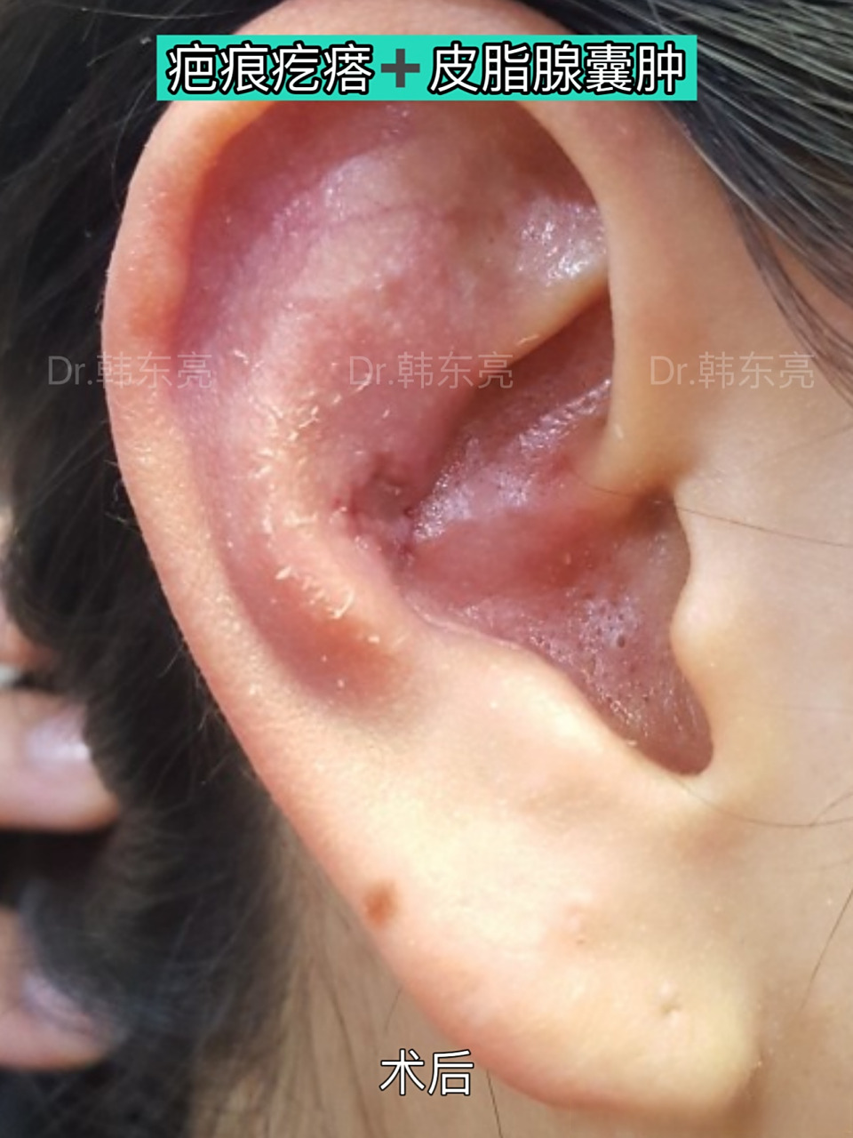 【皮脂腺囊肿引起的耳部疤痕疙瘩】 这位患者的耳朵疤痕疙瘩是皮脂腺
