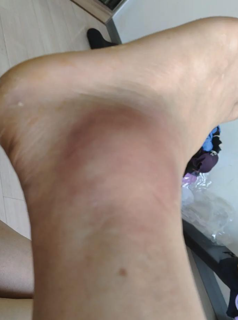 脚扭伤的时候最好别喝酒