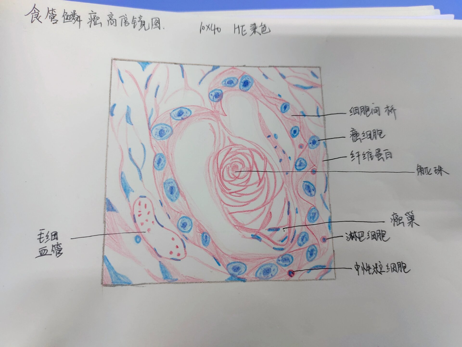 食管鳞癌 病理实验红蓝铅笔绘图