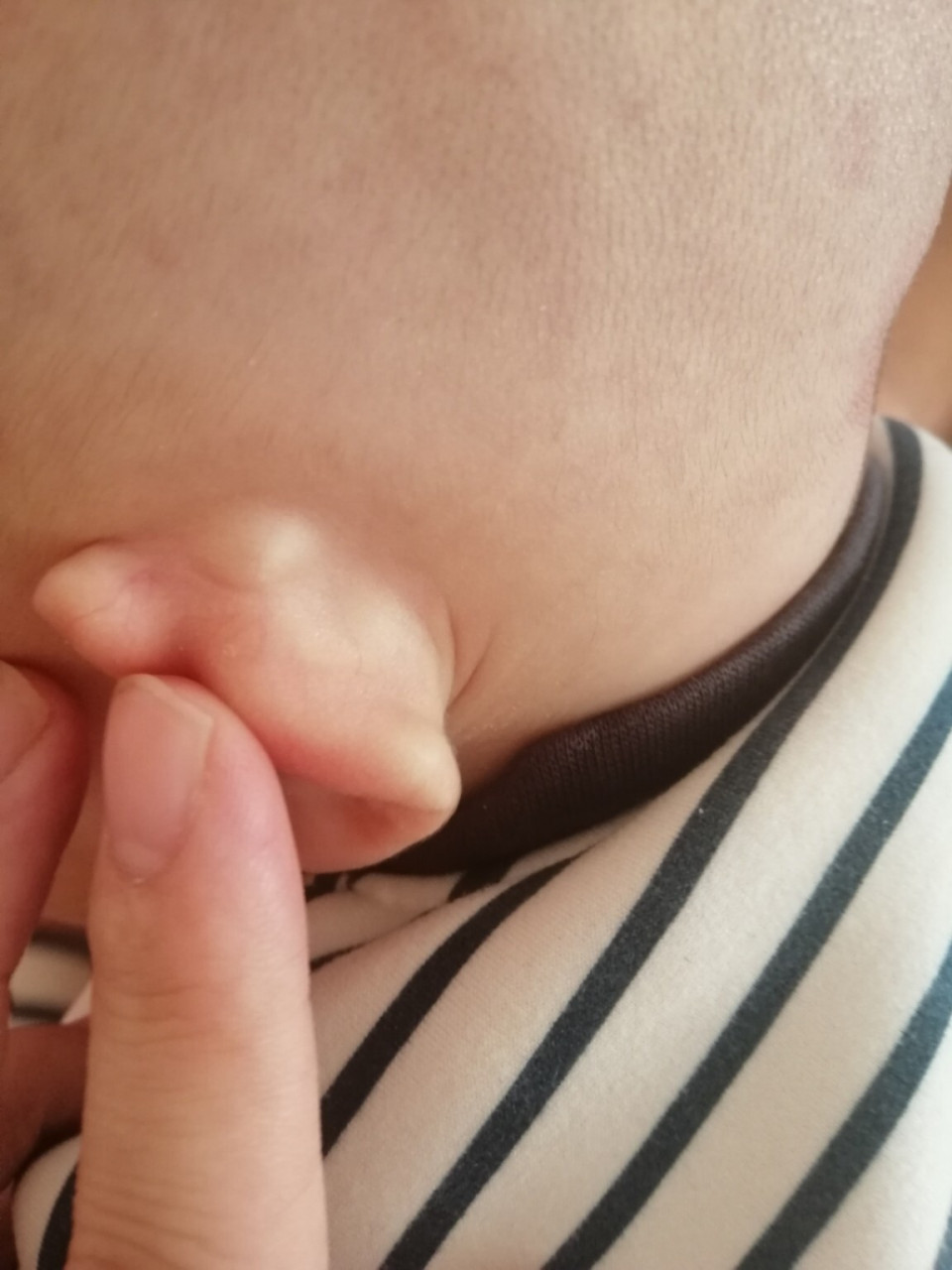 宝宝四个多月,今天发现耳朵后头起的这个疙瘩,有没有宝妈知道这是啥